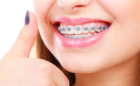 How to Explain braces for childrens teeth to You | tysonbrau501