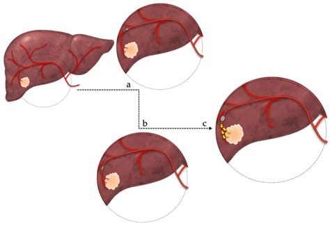 JPM | Free Full-Text | Transarterial Chemoembolization for Hepatocellular Carcinoma: Why, When, How?