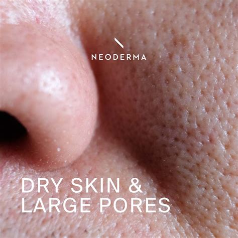 Dry Skin & Large Pores – NEODERMA