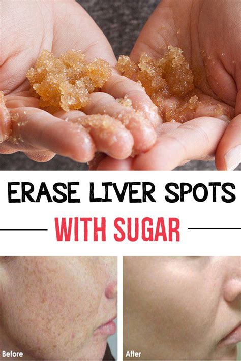 Erase liver spots with sugar - 101 Health Tips | Beauty makeup tips, Beauty care, Beauty care ...