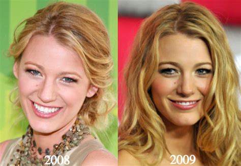 Blake Lively Plastic Surgery Before and After Photos