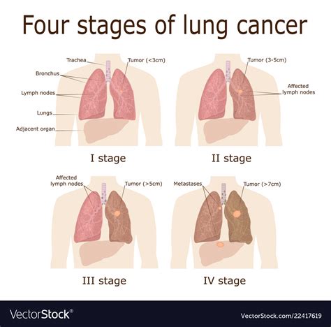 Four stages of lung cancer Royalty Free Vector Image