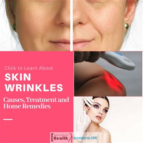 Skin Wrinkles : Causes, Treatment And Home Remedies