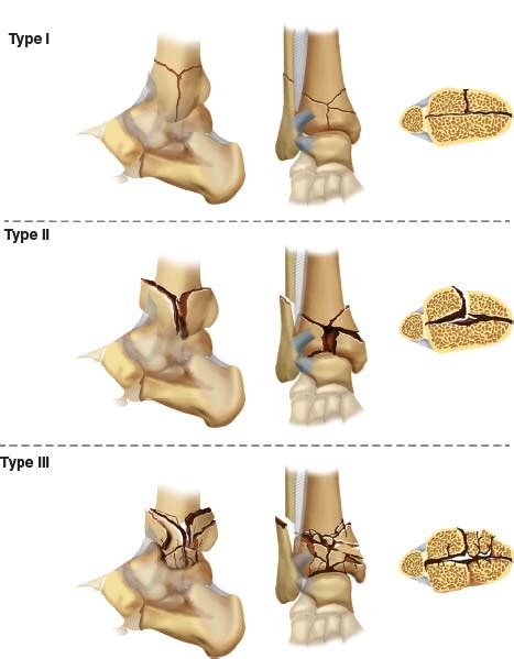 Fractures of the Tibial Plafond | Musculoskeletal Key