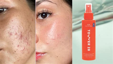 Hypochlorous Acid Spray: Meet the Bacteria-Busting Skin Savior