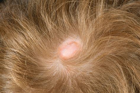 Aplasia cutis congenita - Stock Image - C037/4779 - Science Photo Library