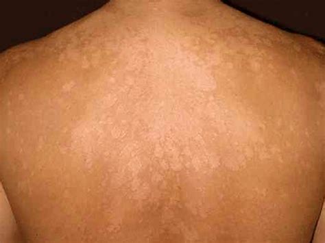 Yeast Fungal Skin Infection : Skin infection pictures and treatments ...