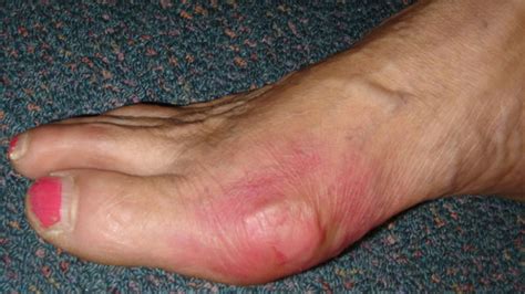 Gout | South West Podiatry