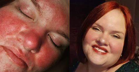 Woman branded a 'tomato' by bullies because of skin condition finds miracle cure - TrendRadars