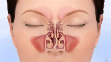 Deviated Nasal Septum Treatment | ENT Associates of San Diego