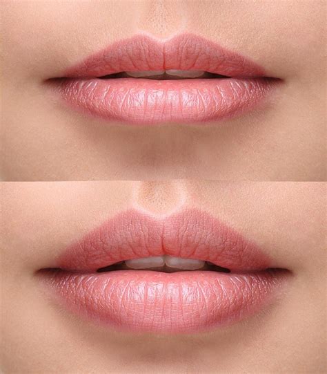 Unlike many other cosmetic procedures, #lip injections have immediate ...