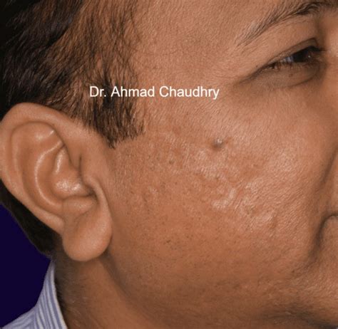 Pitted acne scar treatment Lahore Pakistan | Khadday | Free Checkup