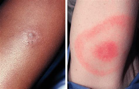 Lyme Disease Rash – 𝗗𝗜𝗔𝗚𝗡𝗢𝗦𝗜𝗦 𝟭𝟮𝟯