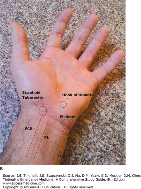 Wrist Bony Anatomy