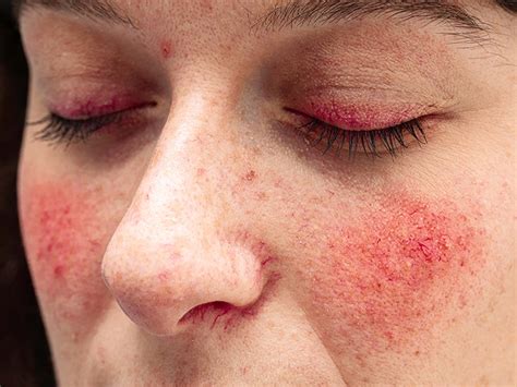 Rosacea: Treatments, types, causes, and symptoms