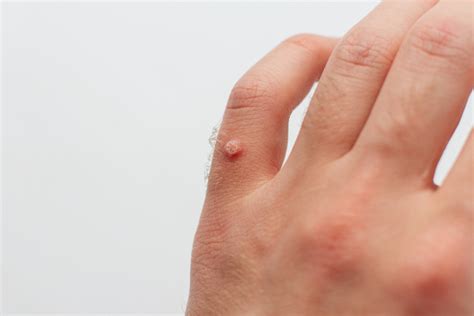 Warts 101: What you need to know about warts and wart removal ...