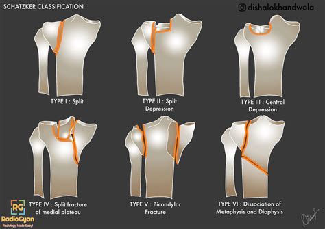 Schatzker Classification of Tibial Plateau Fractures - RadioGyan