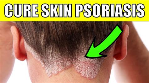 Cure Scalp Psoriasis Permanently With These 7 Natural Remedies - YouTube