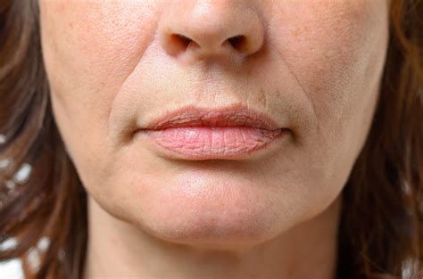 Lip Lines Treatment | Minneapolis, MN | Metropolitan Skin Clinic