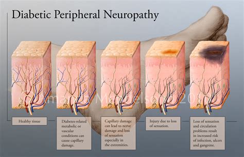 Revisão de conceitos: NEUROPATIA DIABÉTICA