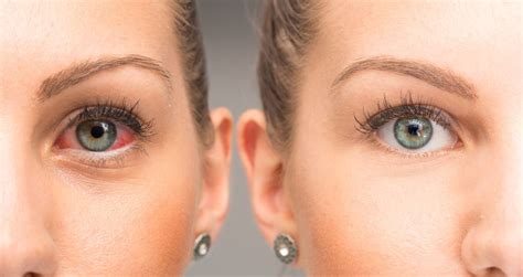 Red Eyes Infection: Causes, Symptoms, and Treatment (Bloodshot Eyes)