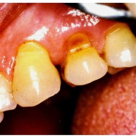 Tooth Abfraction Treatment