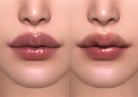 three different angles of lips with the same amount of lip fillers on their cheeks