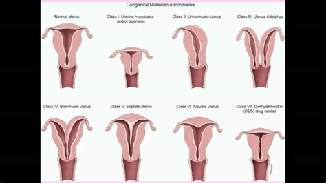 Uterus Didelphys Vs Bicornuate Bicollis - Desaba Fesbynina