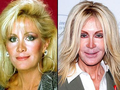 Joan Van Ark Plastic Surgery Before and After Rhinoplasty and Cheek