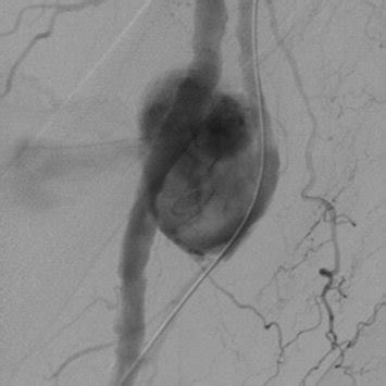 (PDF) Endovascular Stent Graft Management of a Ruptured Profunda Femoris Artery Aneurysm