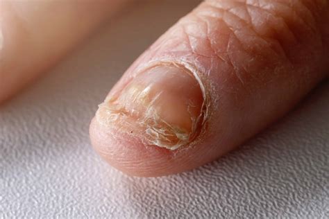 What Are the Causes of a Nail Bed Infection? | Spire Orthopaedic