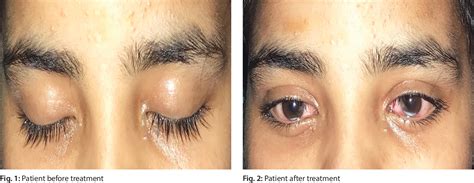 Figure 1 from Krait Snake Bite Presenting as a Cerebral Salt Wasting | Semantic Scholar