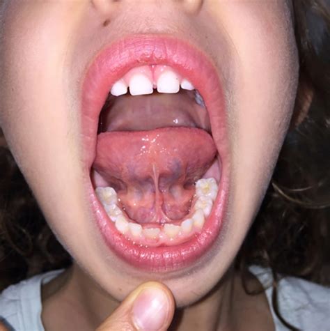 Tongue-Tie (Ankyloglossia ) | Florida E.N.T. & Allergy