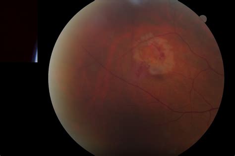 Retinal tear and detachment 1 - The Retina Centers of Washington