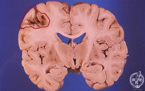 17.Nervous system (2) Cerebral infarction|Pathology Core Pictures