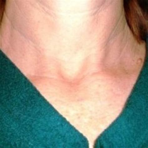 Thyroid Cancer - What to Expect When You've Been Diagnosed | HealDove