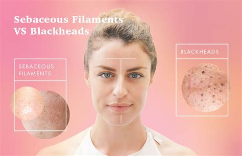 Sebaceous Filaments vs. Blackheads: How to Get Rid of Them | Sebaceous filaments, Blackheads on ...