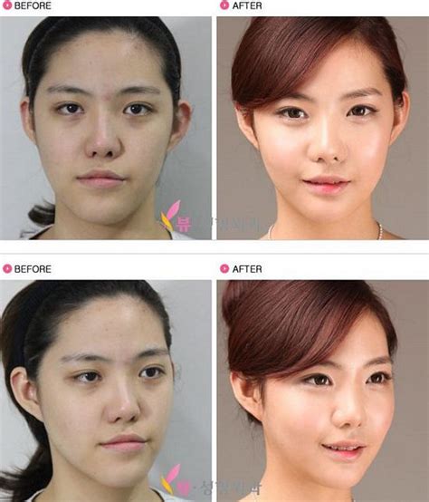 Crazy Before And After Photos Of South Korean Plastic Surgery