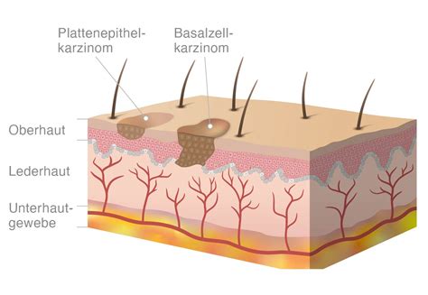 Weißer Hautkrebs? » Symptome • Vorstufe & Stadien • Behandlung | pflege.de