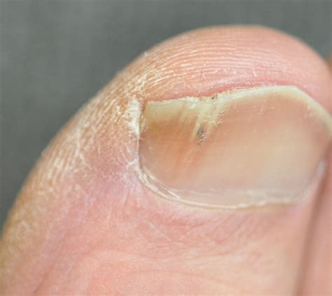 All 95+ Images What Does A Dying Fingernail Look Like Superb 10/2023