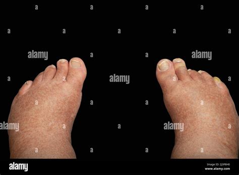 A man with clubfoot (talipes) standing on a black background. Both feet are turned inward ...