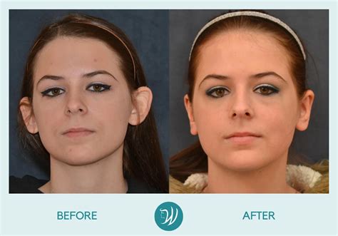 Indianapolis Otoplasty (Ear Pinning Surgery) Before & After Photo Gallery