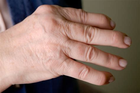 Psoriatic arthritis - NHS