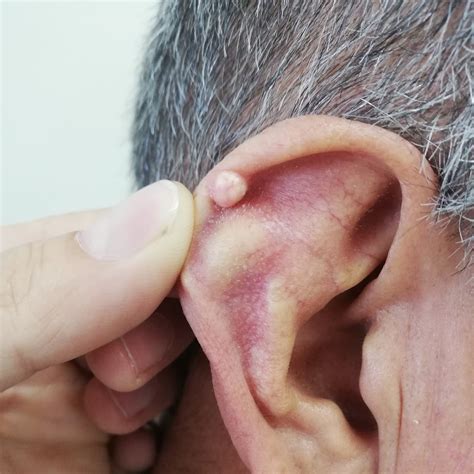 Tophus Ear