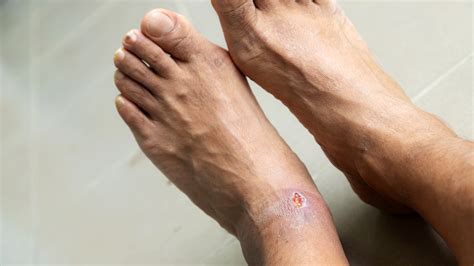 What Are Diabetic Foot Ulcers? Causes, Stages, and Treatment - GoodRx