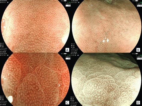 Blue Laser Imaging and Magnification Endoscopy as a Tool for the ...