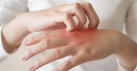 Home Remedies for Skin Abrasion