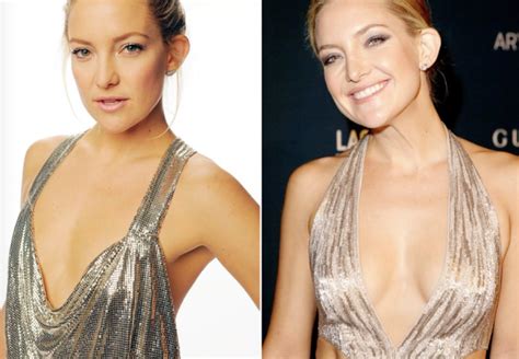 Breast Augmentation Before And After: Celebrity Edition — Atlantic Health Solutions