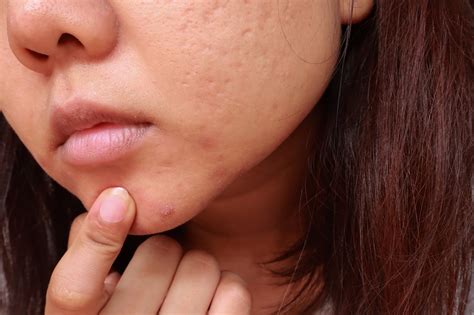 What to Know About Treating Cystic Acne, Per Dermatologists | POPSUGAR Beauty UK