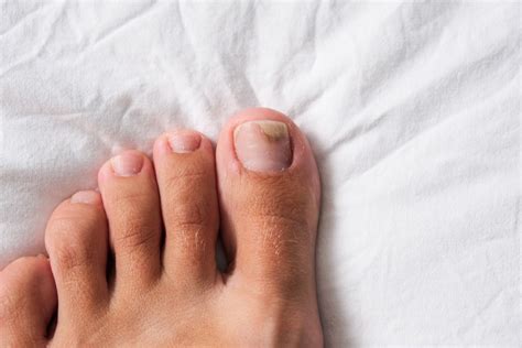 How To Know If Toenail Fungus Is Dying | Noodls